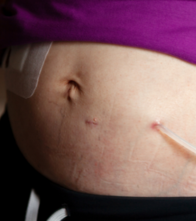 Understanding Home Dialysis